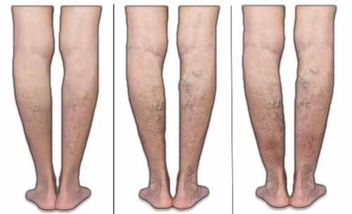Stages of varicose veins
