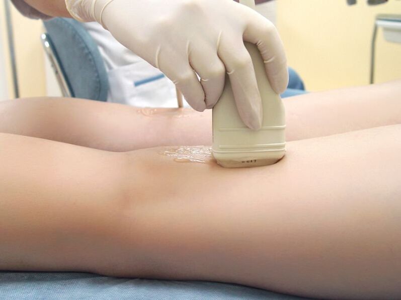 The treatment of varicose veins