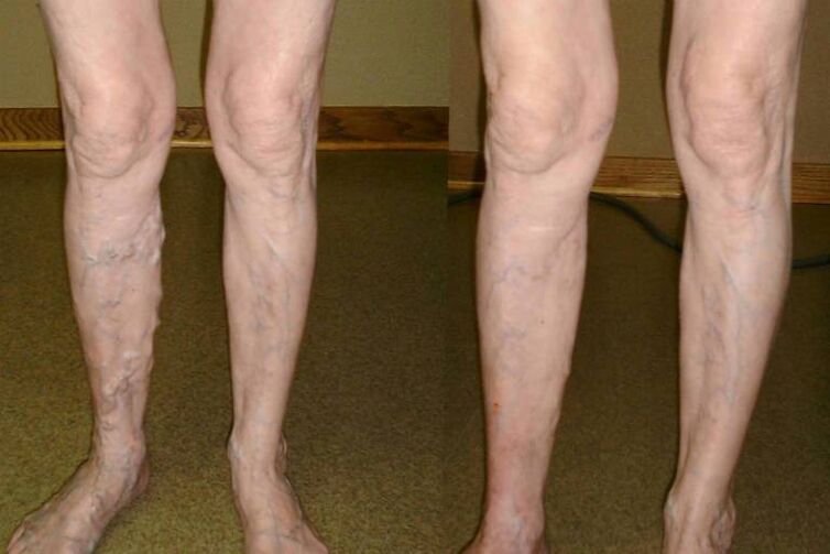 Varicosis veins in men