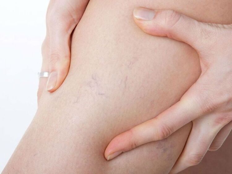 Varicosis veins in the legs