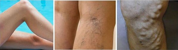 Varicosis of Varicosis in the legs