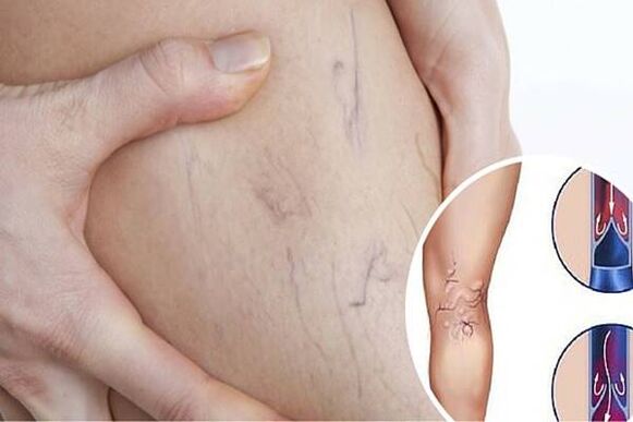 Varicosis veins Photo