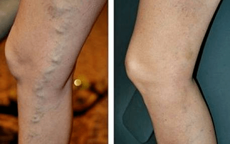 Varicosis veins before and after