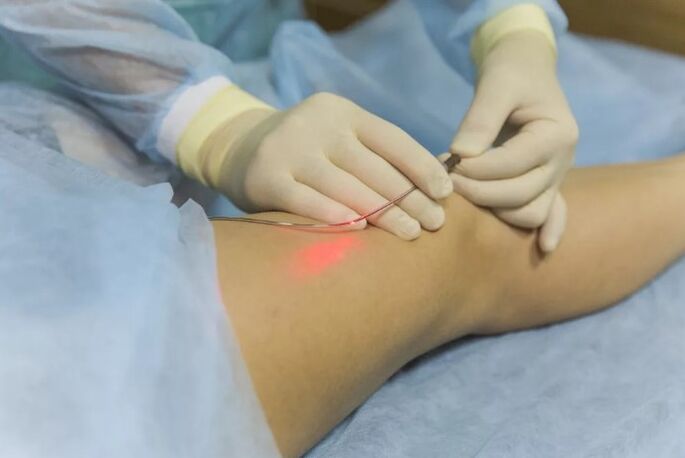 Treatment of varicose veins with laser