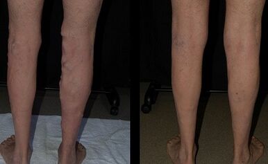Treatment with laser picture before and after the treatment of varicose veins