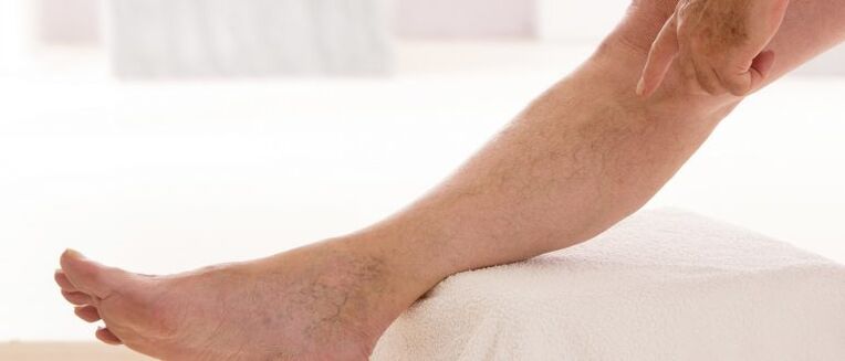 Varicosis veins in the legs