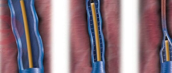 The essence of the degree of radiofrequency in the treatment of varicose veins